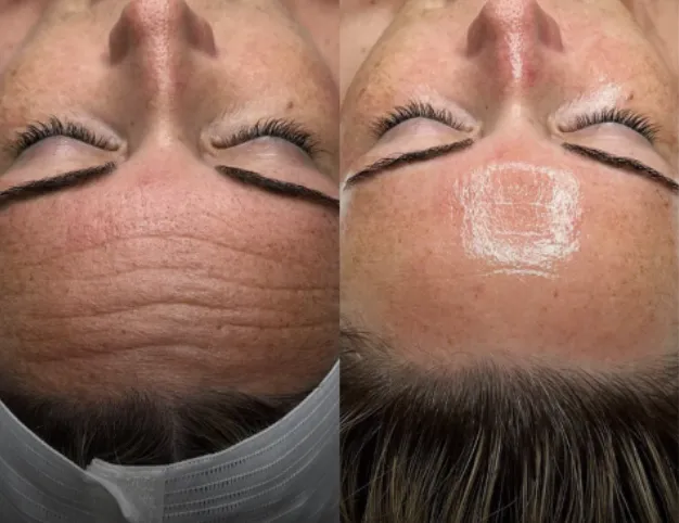 Före och efter HydraFacial: jämnare hud i pannan