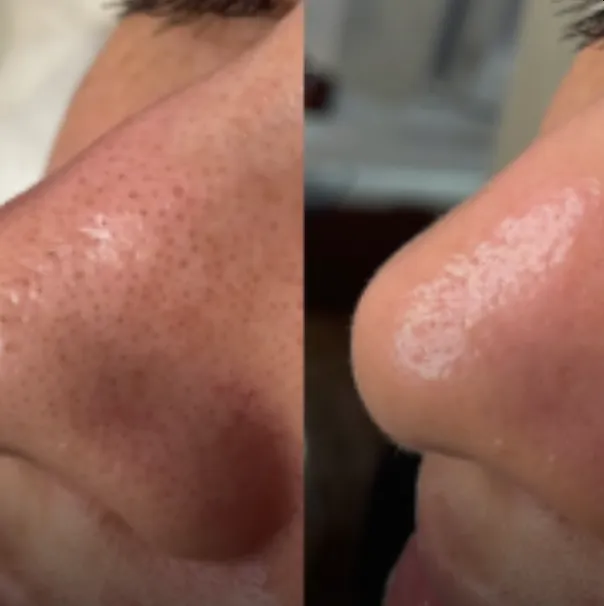 Före och efter HydraFacial: renare porer på näsan
