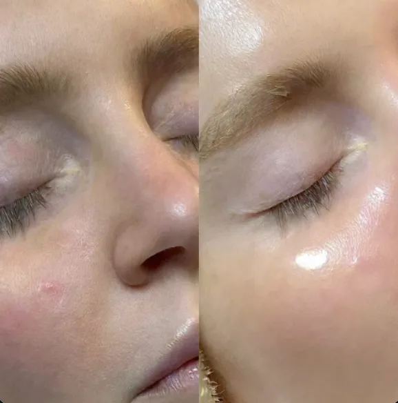 Före och efter HydraFacial: glow och jämnare hudton i ansiktet